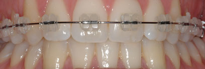 Bagues transparentes Clarity® Bagues transparentes Clarity®